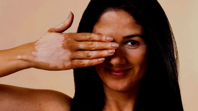 woman with vitiligo