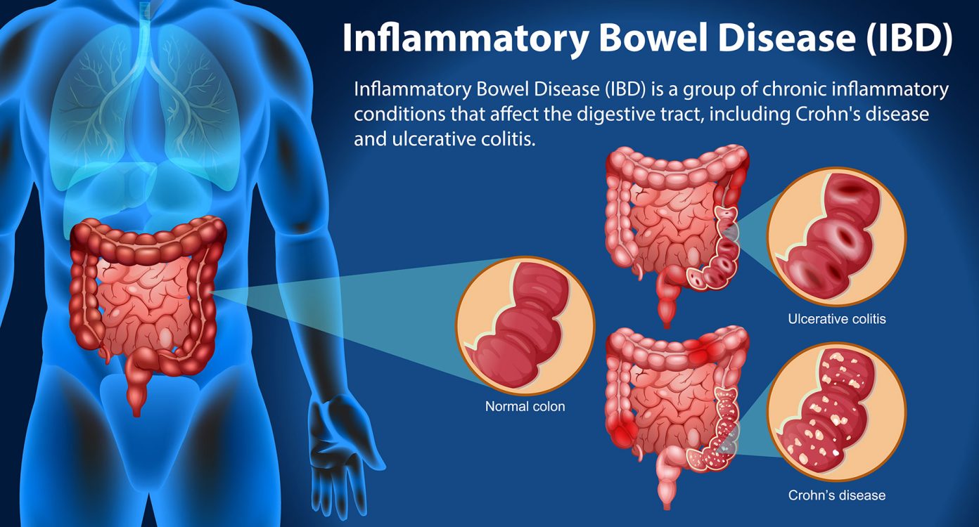Inflammatory bowel disease infographics